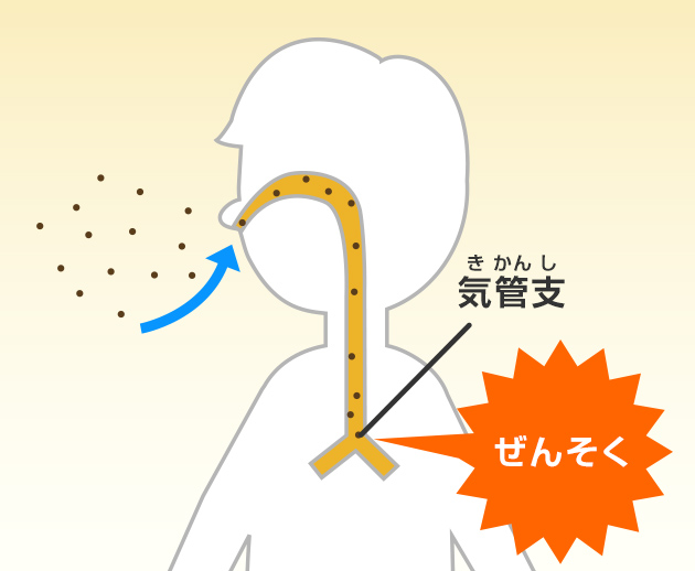 ダニの死がいやふんは鼻を通って気管支までとどき、ぜんそくの原因になる